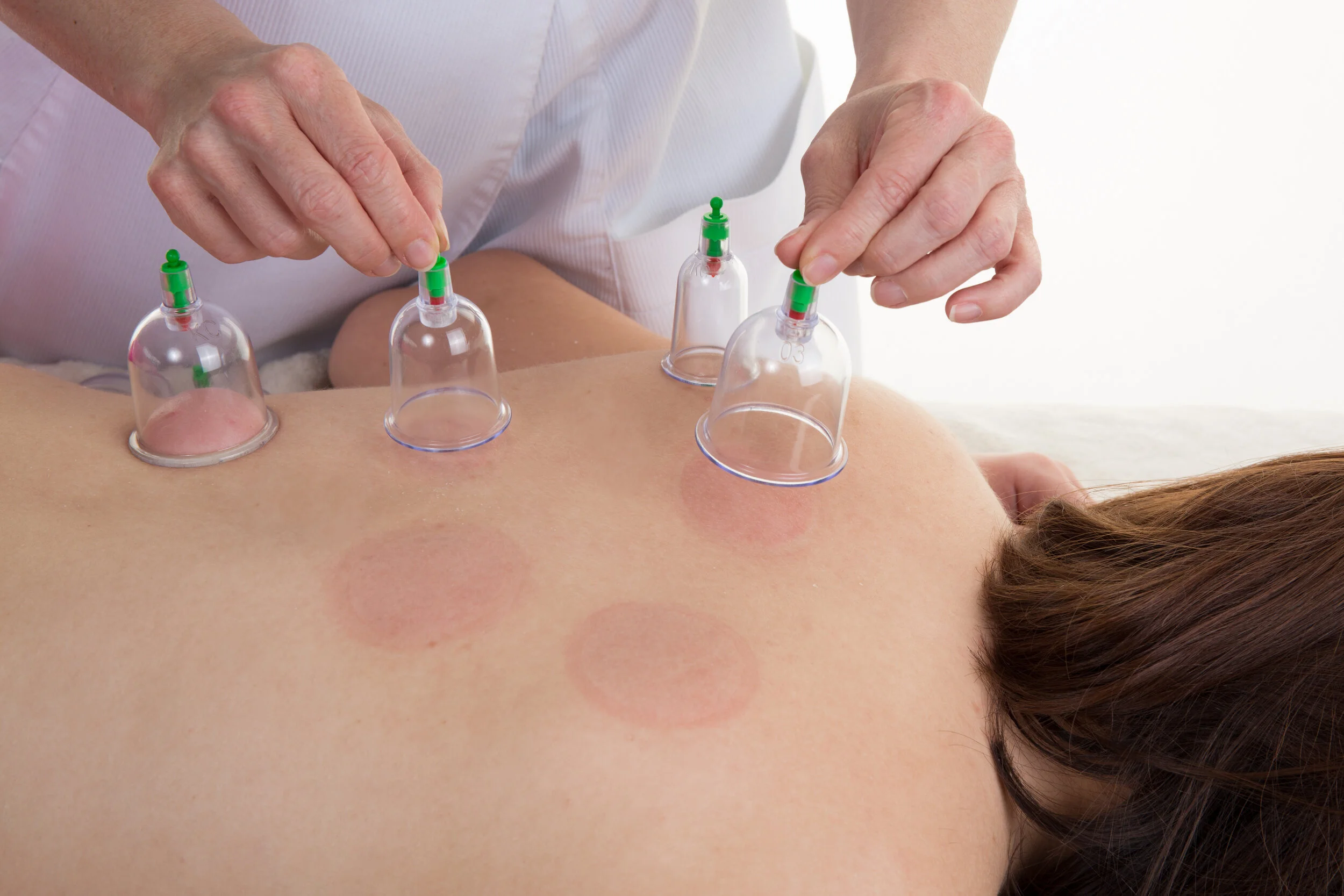 Cupping Therapy Christchurch | Advanced Acupuncture for Muscle Relief & Wellness