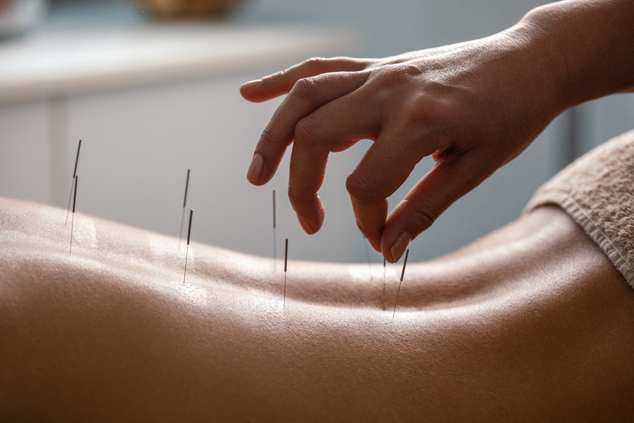 Acupuncture Christchurch – Holistic Therapies for Pain Relief and Wellbeing
