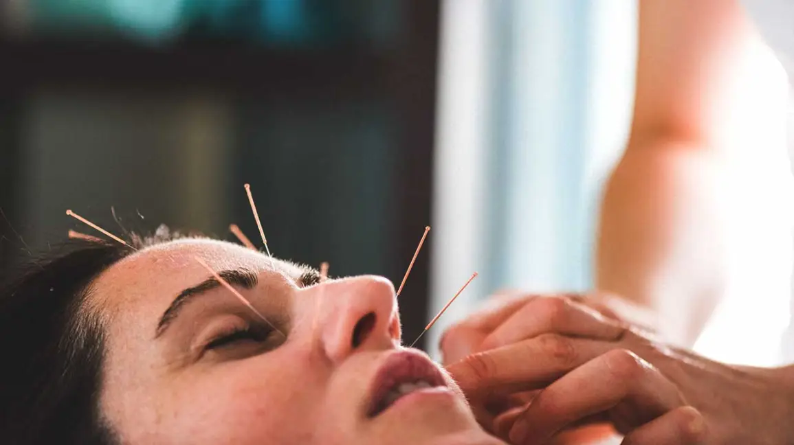 Acupuncture for Pain Relief in Christchurch