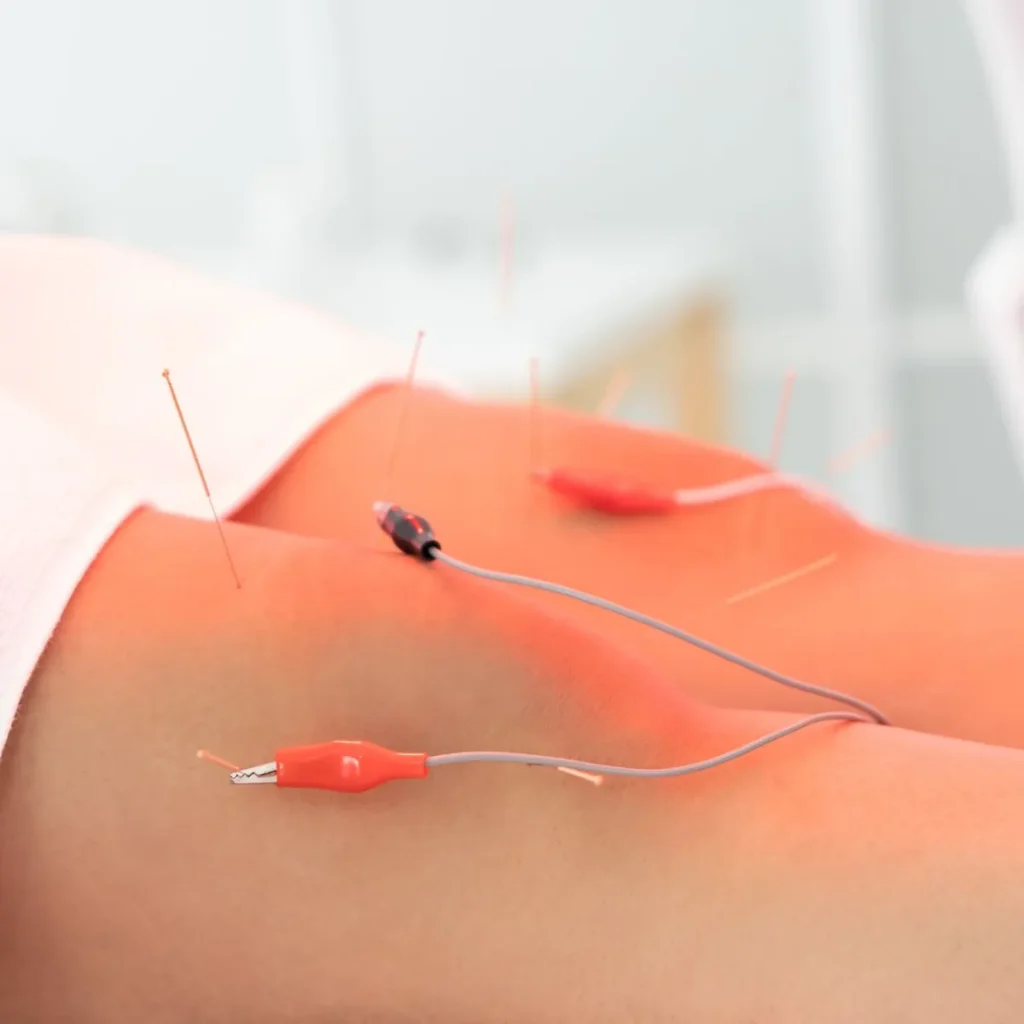 electro-acupuncture