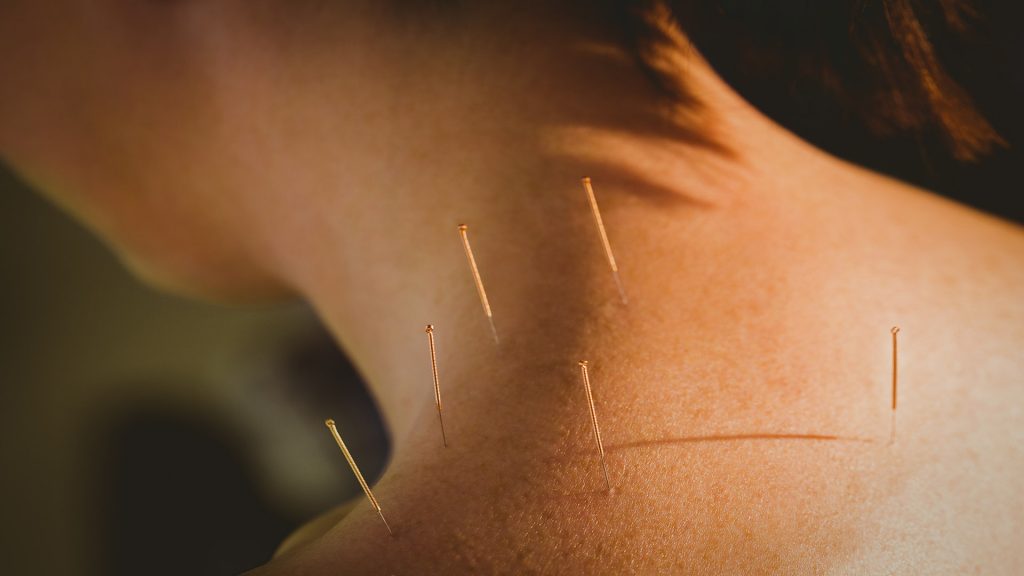 acupuncture in Christchurch