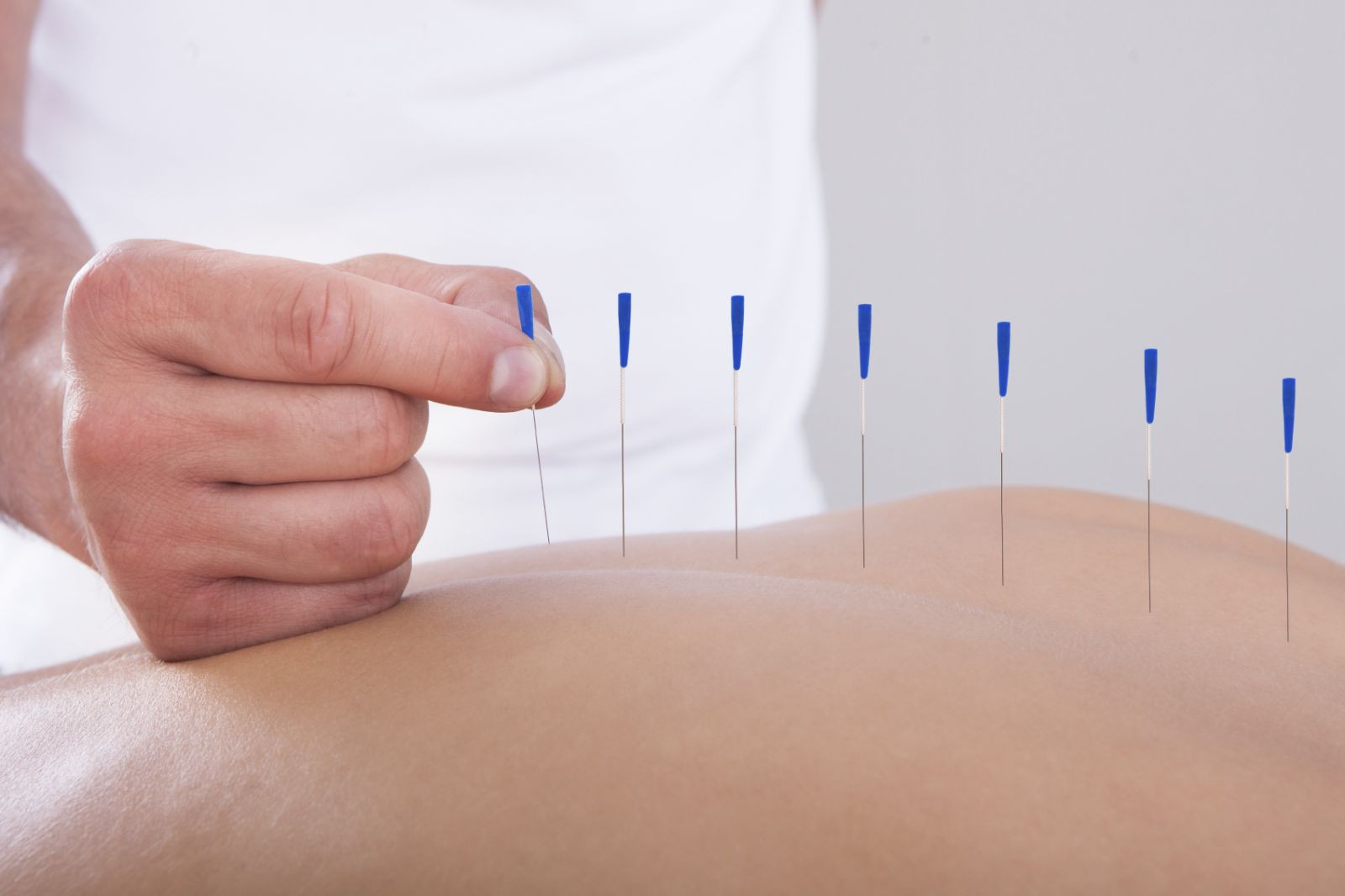 Advanced Acupuncture Christchurch | Best Acupuncture Christchurch Clinic