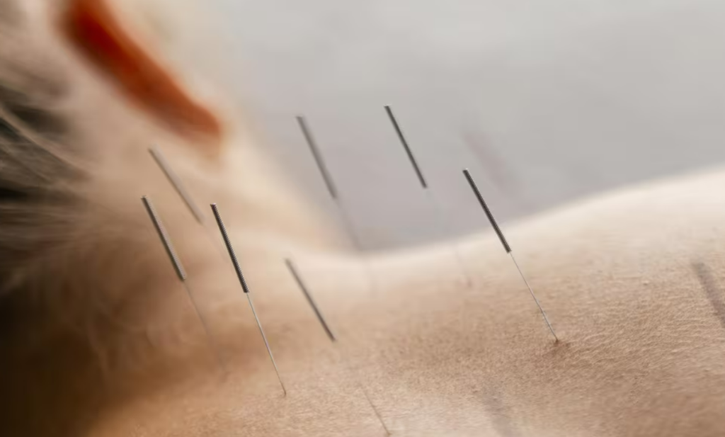 Acupuncture Christchurch