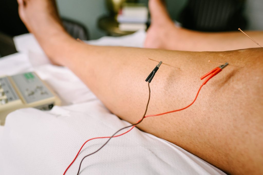 electro acupuncture-Christchurch