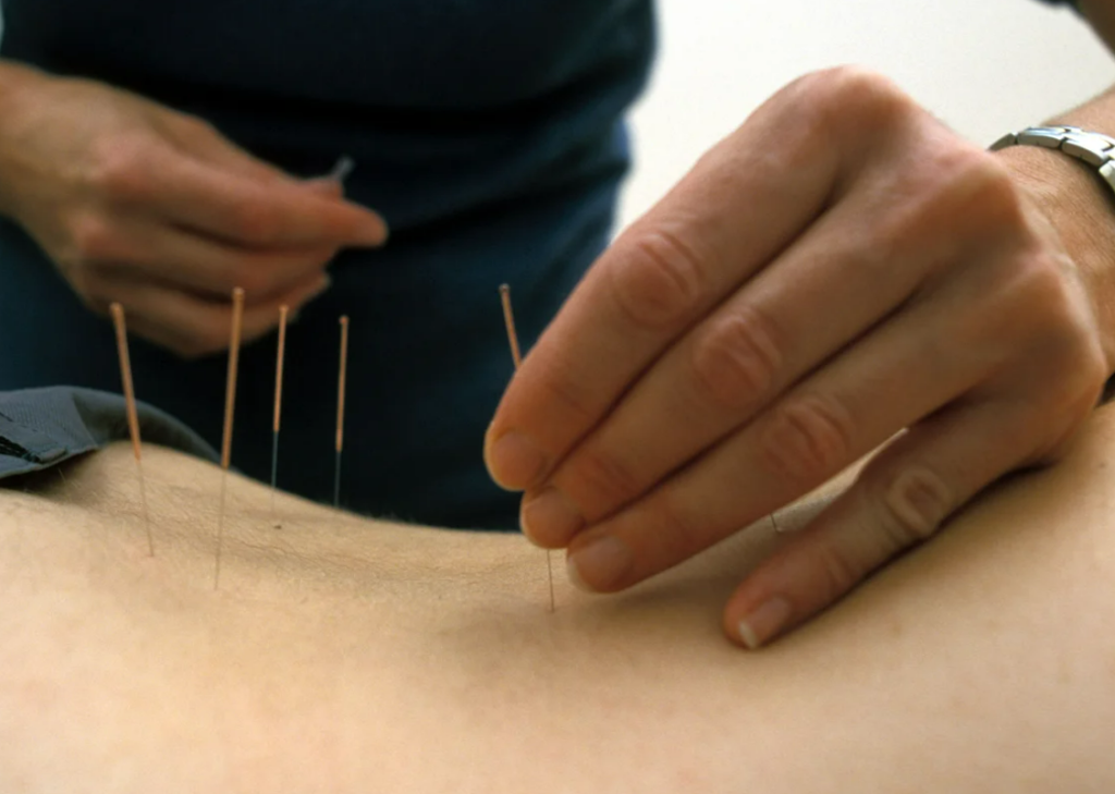 Pain Relief Acupuncture Christchurch