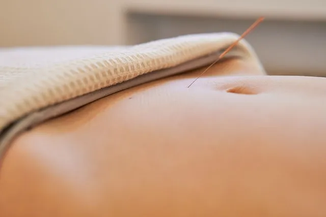 Advanced Acupuncture Christchurch